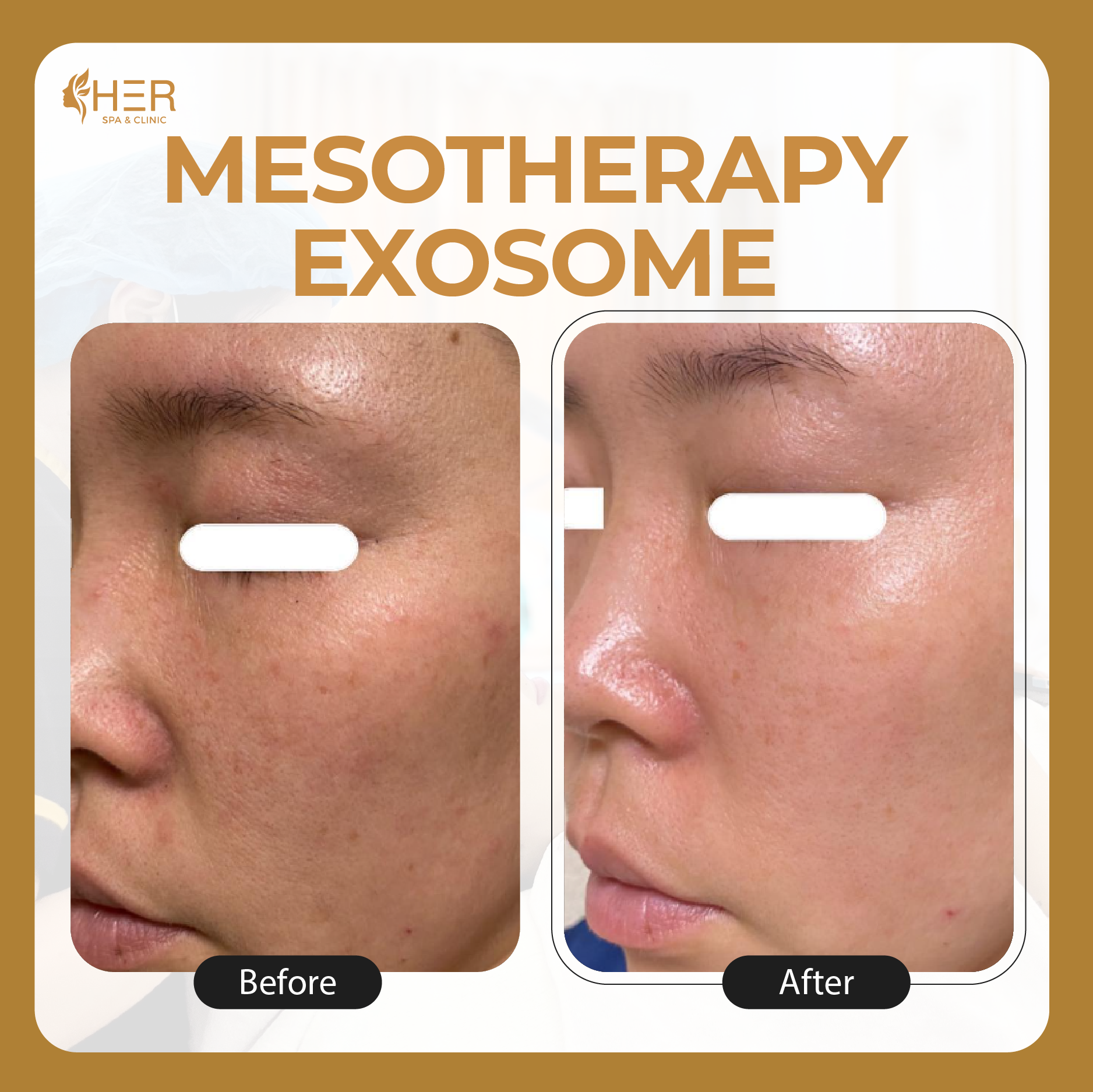 Mesotherapy Exosome - Mesoexsome tăng cường tế bào gốc